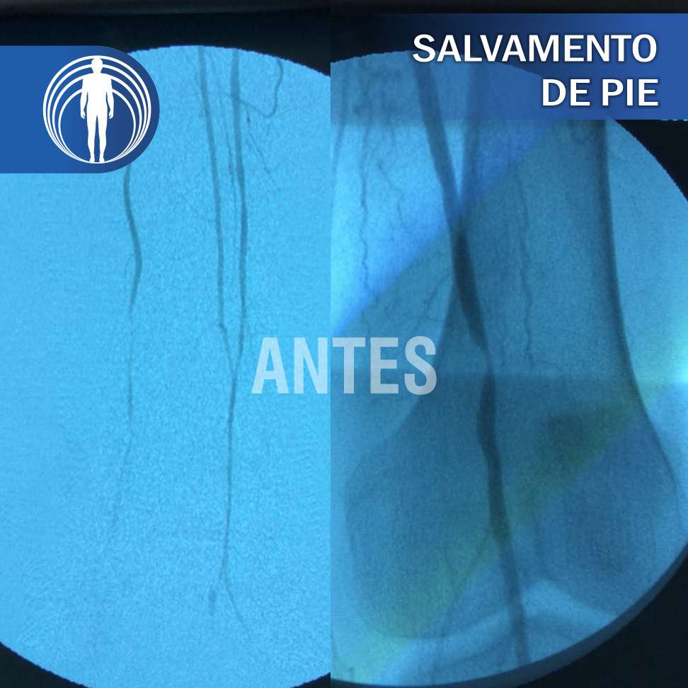 pie diabetico